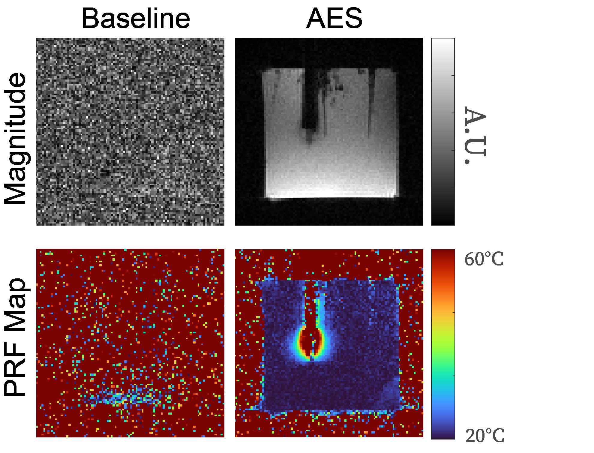 Active EMI suppression for MRI-guided microwave ablation