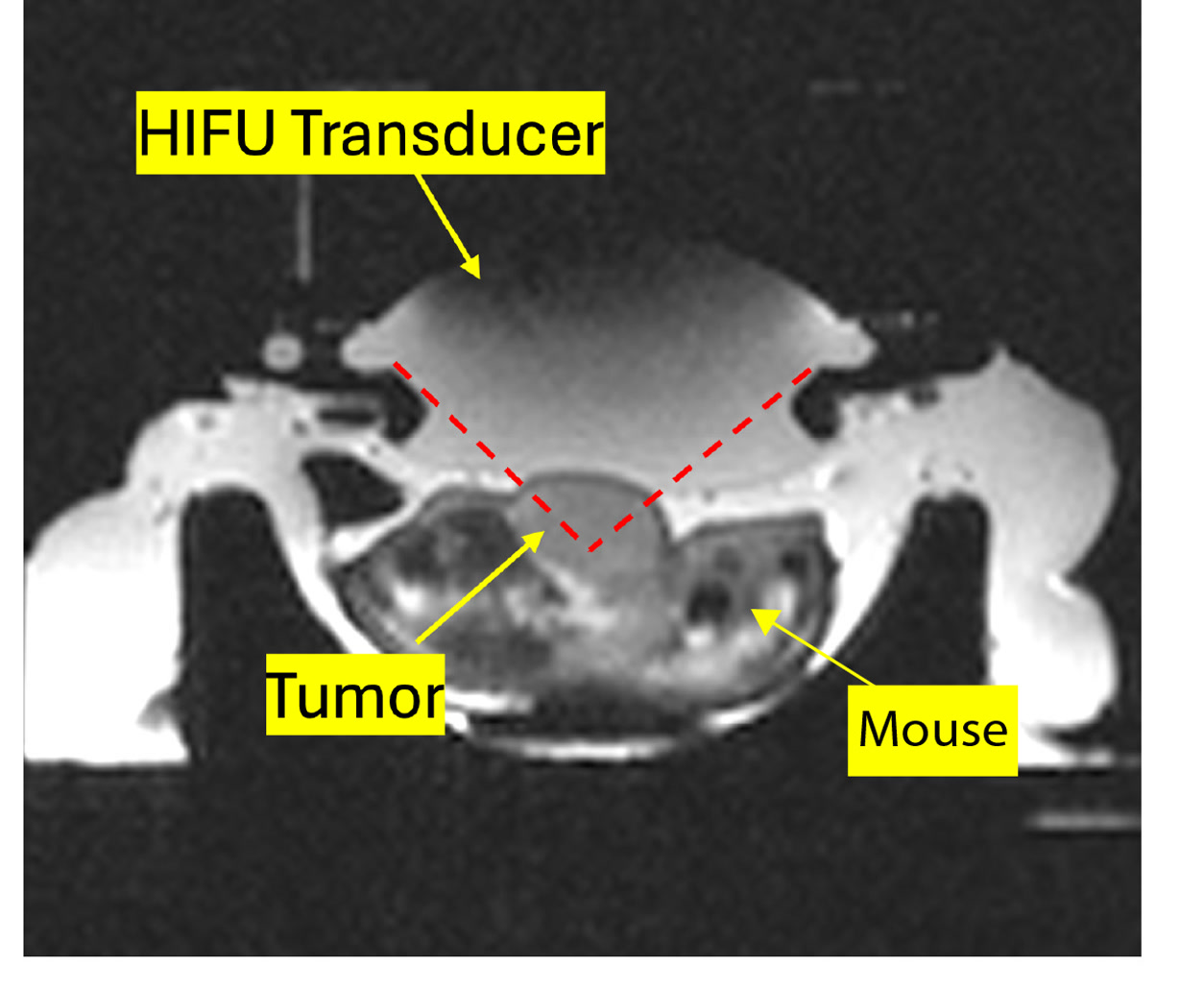 MRI-guided HIFU-triggered drug delivery in murine colorectal tumor models