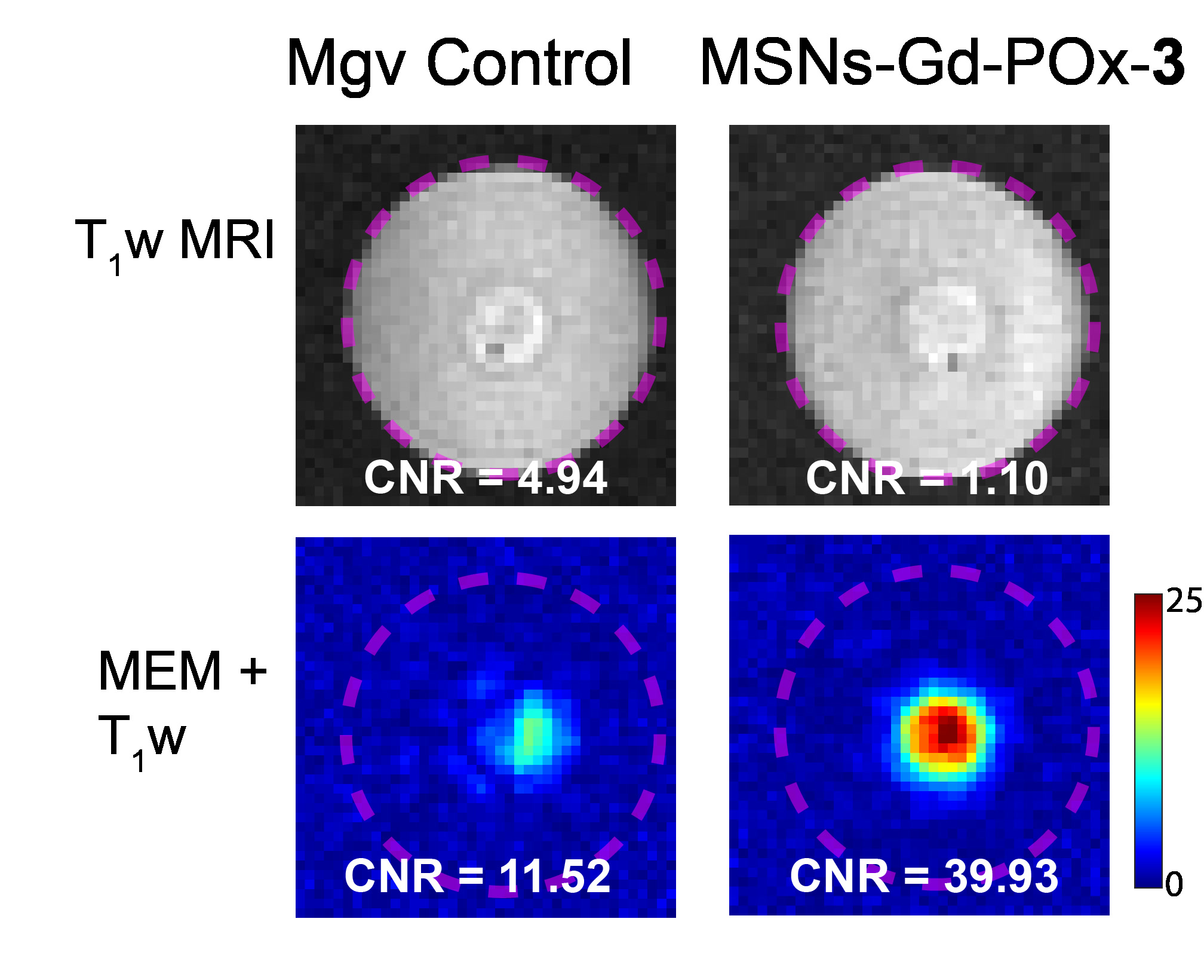 HIFU-activated MRI 'spotlight' on the nanoparticle region