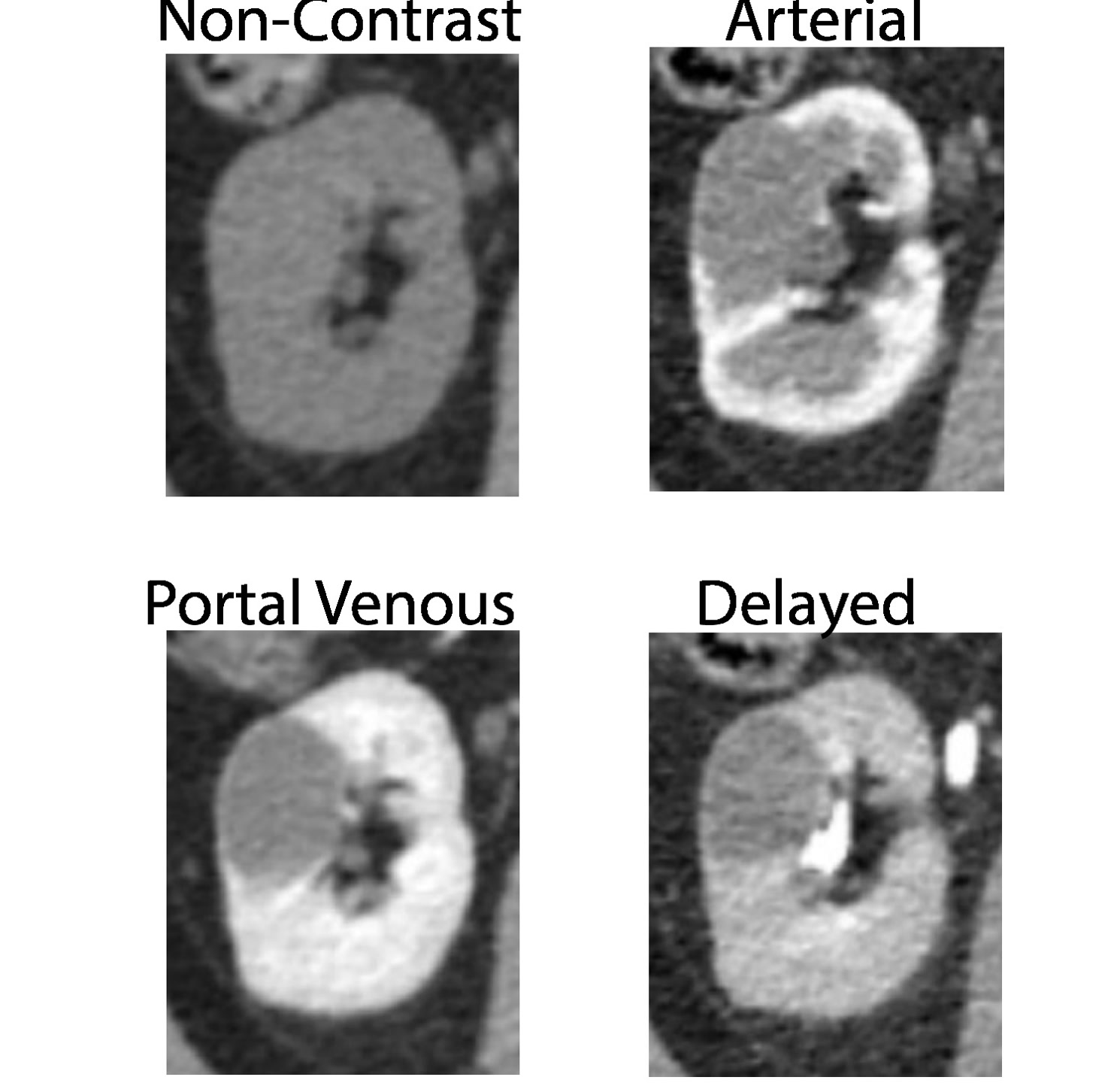 Multi-phase renal tumor CT from the UCSF RMaC dataset