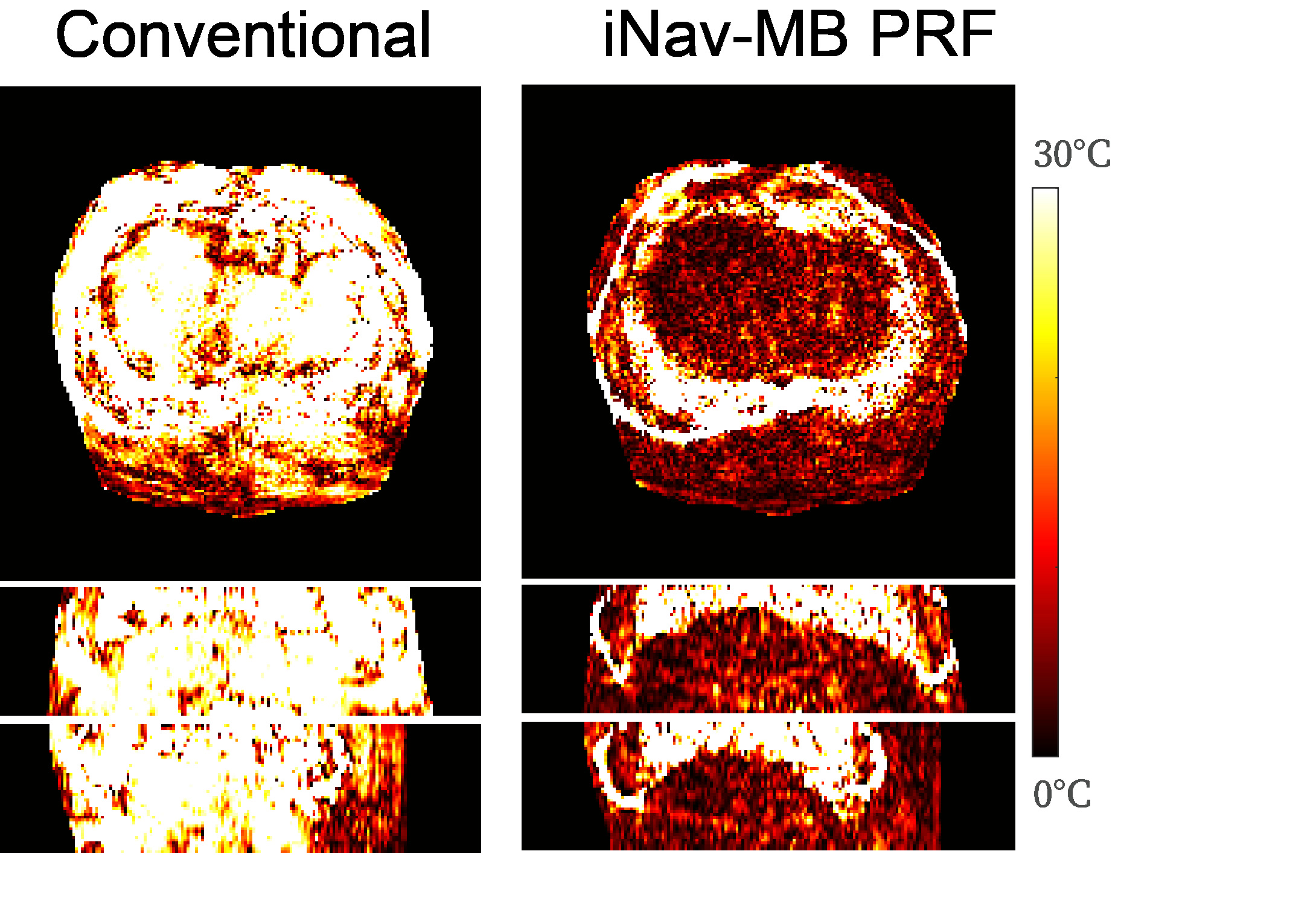 Motion-robust 3D temperature mapping in the liver